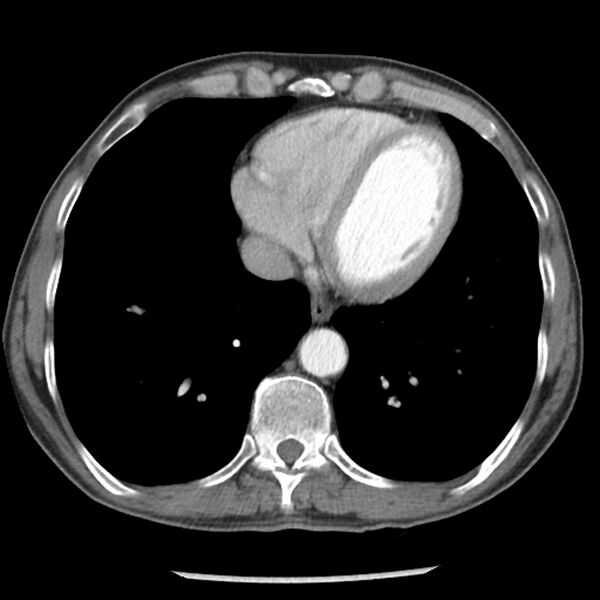 File:Adenocarcinoma of the lung - micropapillary predominant (Radiopaedia 42446-45563 Axial C+ portal venous phase 54).jpg