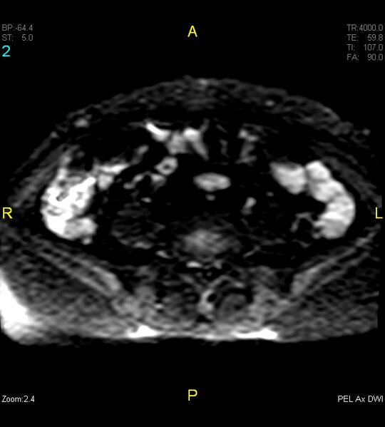 File:Adenomyosis (Radiopaedia 43504-46889 Axial DWI 2).jpg