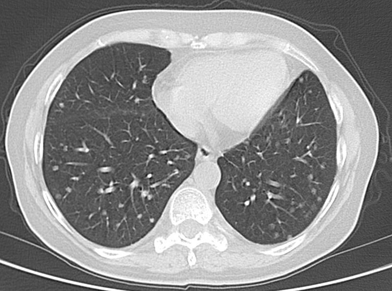 File:Adenosquamous lung carcinoma (Radiopaedia 22035-22030 lung window 43).jpg