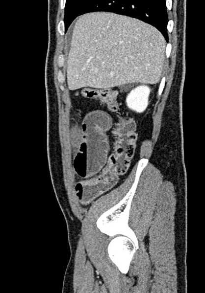File:Adhesional small bowel obstruction (Radiopaedia 58900-66131 Sagittal C+ portal venous phase 51).jpg