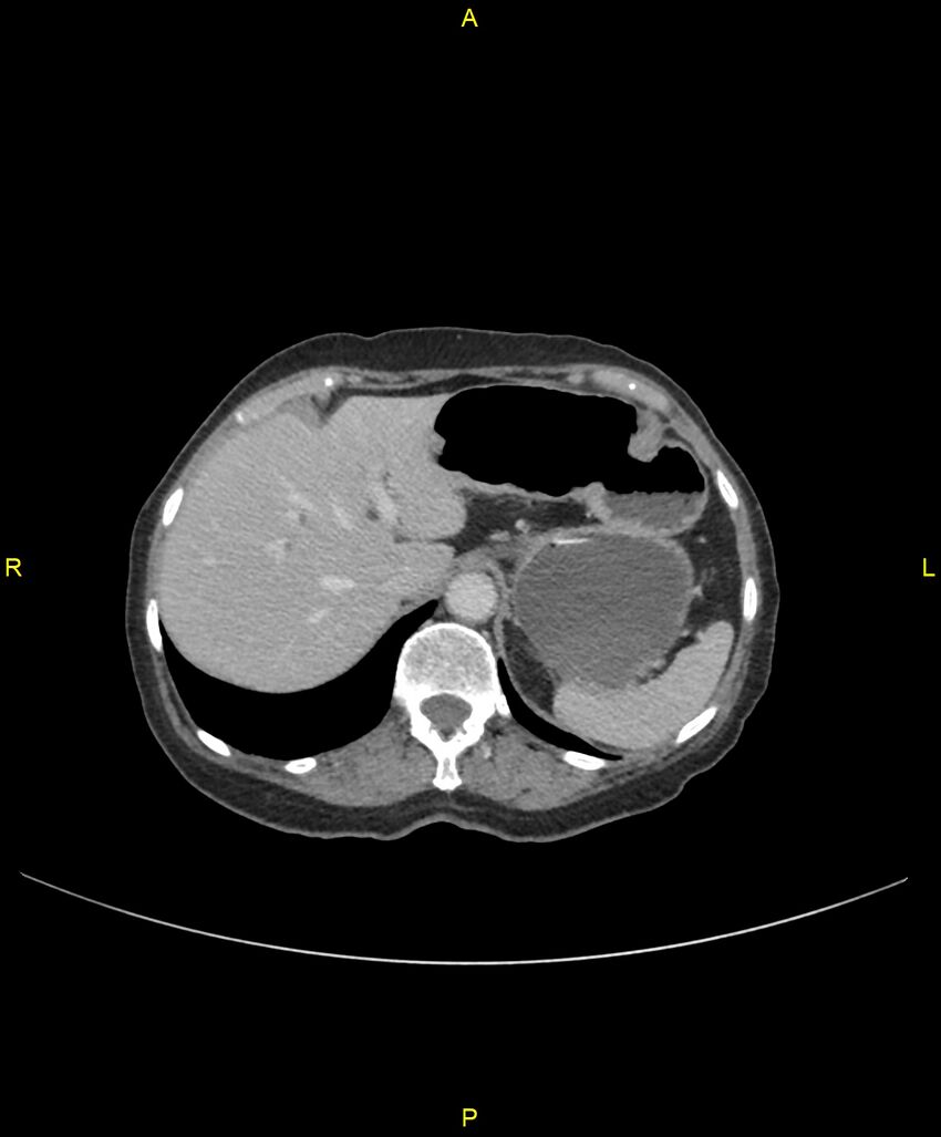 Adhesional small bowel obstruction (Radiopaedia 85402-101024 Axial C+ portal venous phase 58).jpg