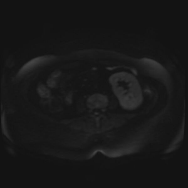 File:Adrenal cortical carcinoma (Radiopaedia 70906-81116 Axial DWI 52).jpg