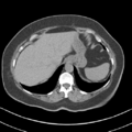 Adrenal hemangioma (Radiopaedia 33078-34103 Axial non-contrast 9).png