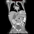 Adrenal hemorrhage (Radiopaedia 9390-10077 Coronal C+ portal venous phase 5).jpg