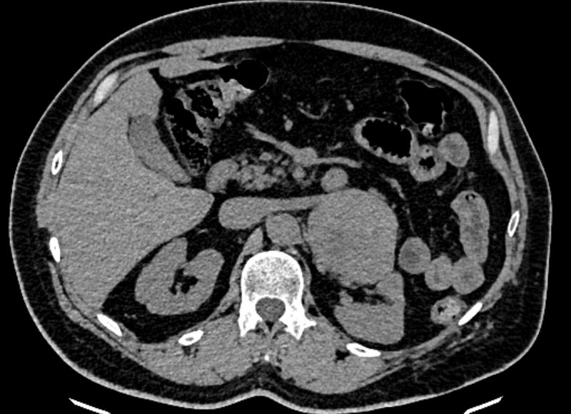 File:Adrenal metastases (Radiopaedia 73082-83791 Axial non-contrast 64).jpg