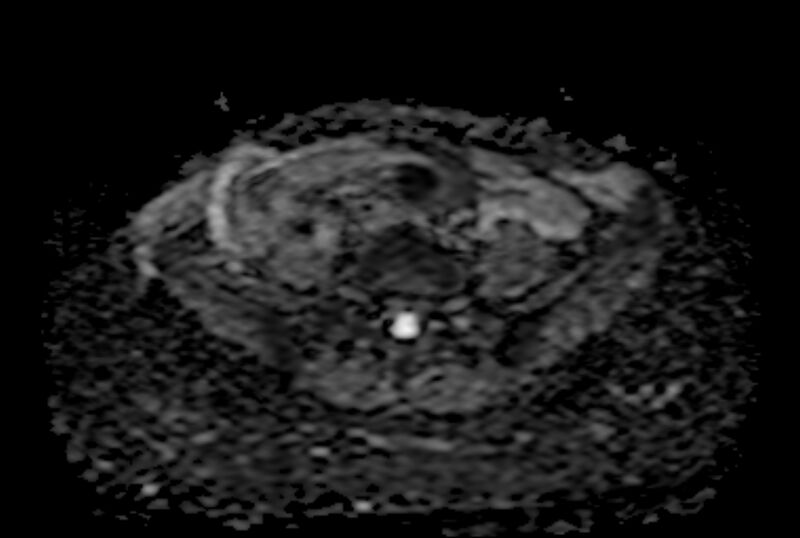 File:Adult granulosa cell tumor of the ovary (Radiopaedia 71581-81950 Axial ADC 5).jpg