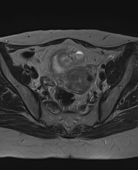 File:Adult granulosa cell tumor of the ovary (Radiopaedia 71581-81950 Axial T2 12).jpg
