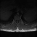 Aggressive vertebral hemangioma (Radiopaedia 39937-42404 Axial T1 13).png