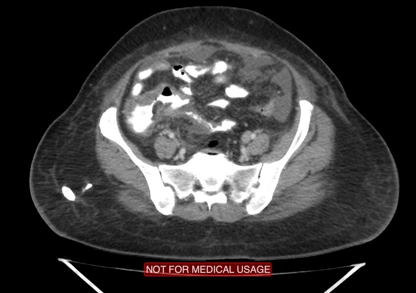 Amoebic enterocolitis with liver abscess (Radiopaedia 35100-36609 A 62).jpg