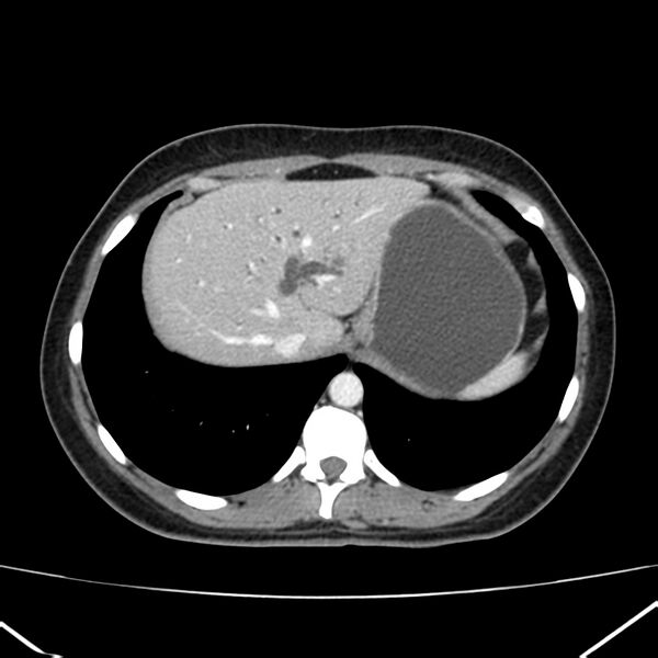 File:Ampullary tumor (Radiopaedia 22787-22816 C 10).jpg