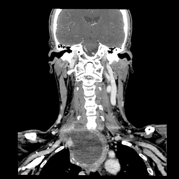 File:Anaplastic thyroid carcinoma (Radiopaedia 79087-92034 A 71).jpg