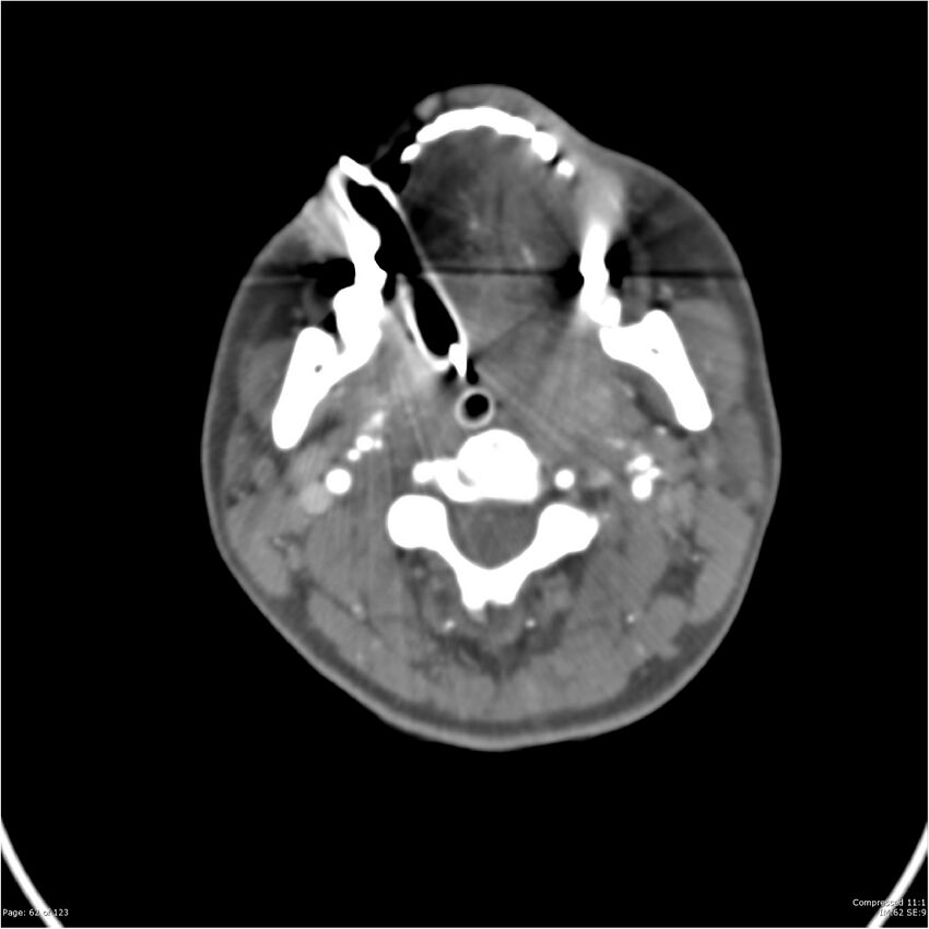 Aneurysmal subarachnoid hemorrhage and Moya Moya disease (Radiopaedia 34306-35593 Axial CT COW 62).jpg