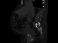 Ankylosing spondylitis (Radiopaedia 44609-48357 Sagittal bone window 44).jpg