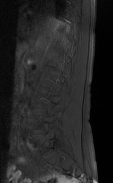 File:Ankylosing spondylitis - Andersson lesion (Radiopaedia 81878-95838 Sagittal T1 fat sat 10).jpg