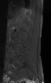 Ankylosing spondylitis - Andersson lesion (Radiopaedia 81878-95838 Sagittal T1 fat sat 10).jpg