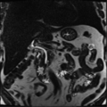 Annular pancreas (Radiopaedia 38292-40320 Coronal T2 15).png