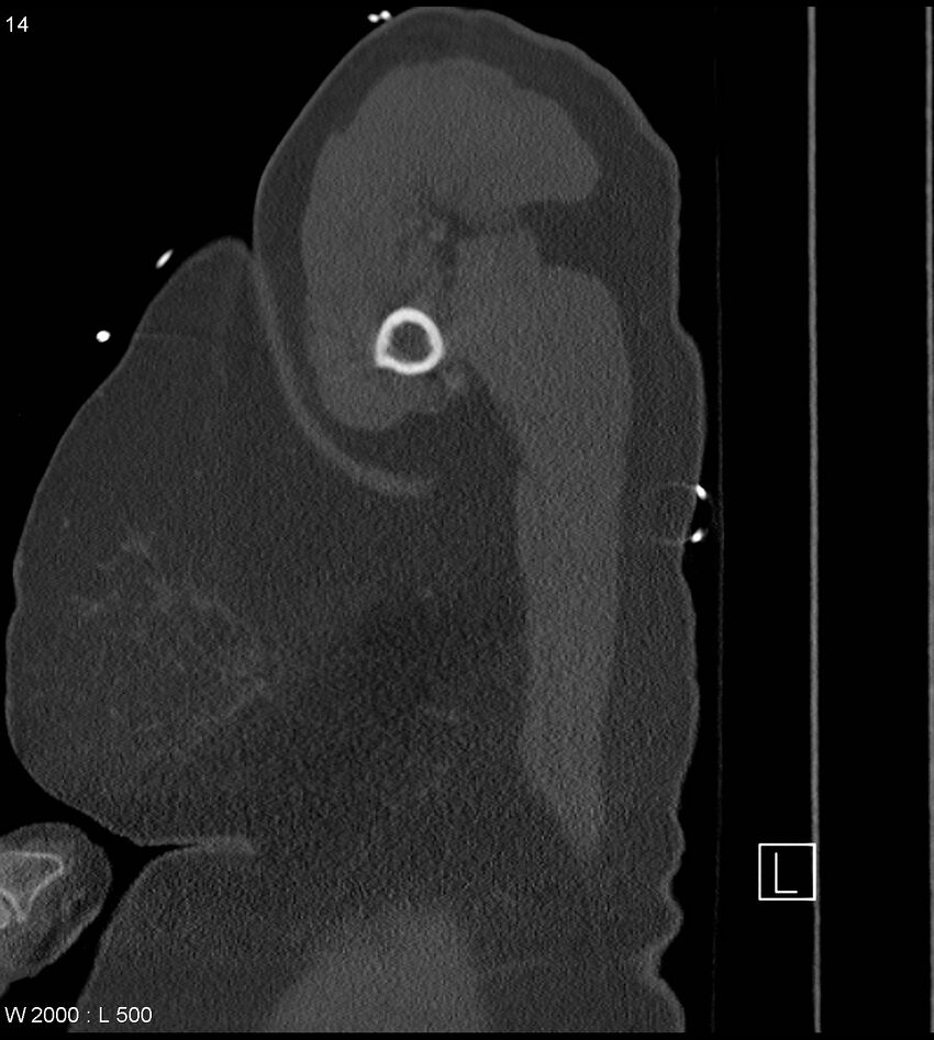 Anterior shoulder dislocation (CT) (Radiopaedia 59032-66309 Sagittal bone window 7).jpg