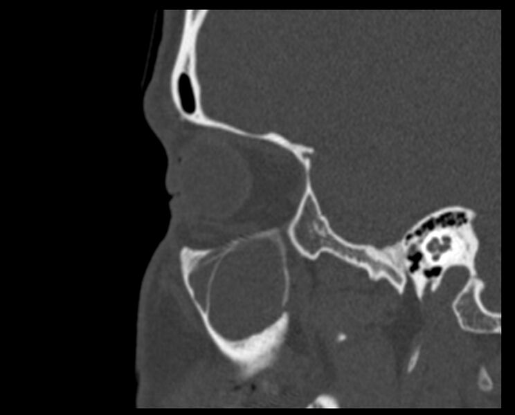 File:Antrochoanal polyp (Radiopaedia 21894-21868 Sagittal bone window 7).jpg
