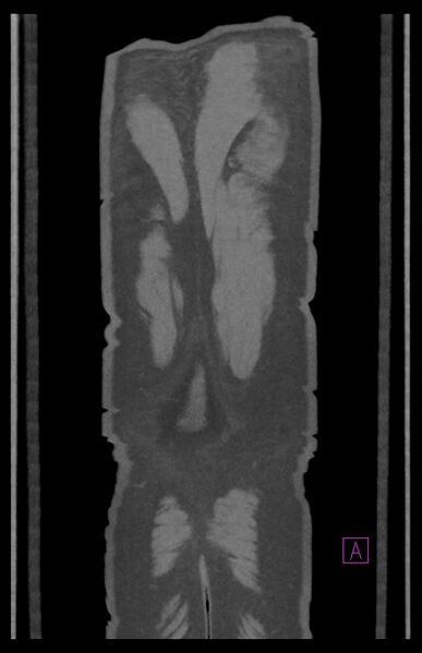 File:Aortectomy and axillary-bifemoral bypass (Radiopaedia 28303-28545 C 90).jpg
