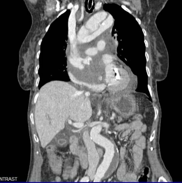 File:Aortic dissection - Stanford type A (Radiopaedia 20760-20675 B 2).jpg