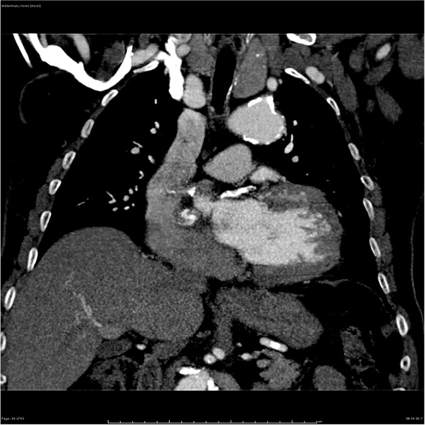Aortic dissection - Stanford type A (Radiopaedia 26183-26315 A 26).jpg