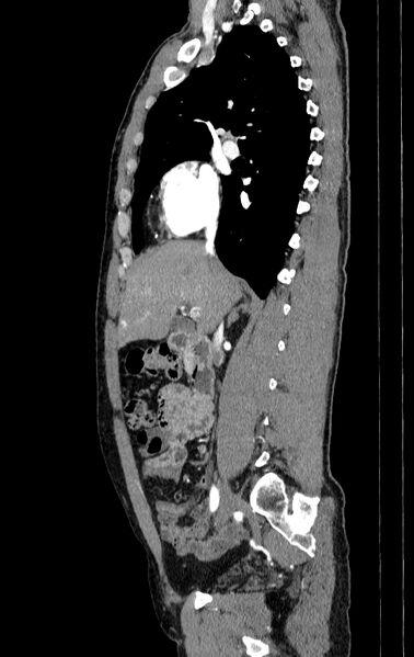 File:Aortic dissection - Stanford type A (Radiopaedia 83418-98500 B 11).jpg