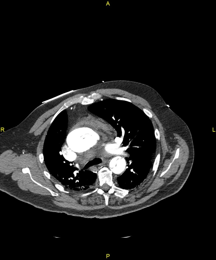 Aortic rupture (Radiopaedia 88822-105594 B 89).jpg