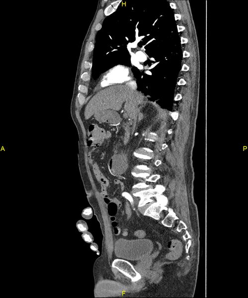 File:Aortoenteric fistula (Radiopaedia 84308-99603 C 145).jpg