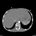 Aortopulmonary window, interrupted aortic arch and large PDA giving the descending aorta (Radiopaedia 35573-37074 B 87).jpg