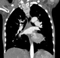 Aortopulmonary window, interrupted aortic arch and large PDA giving the descending aorta (Radiopaedia 35573-37074 D 41).jpg