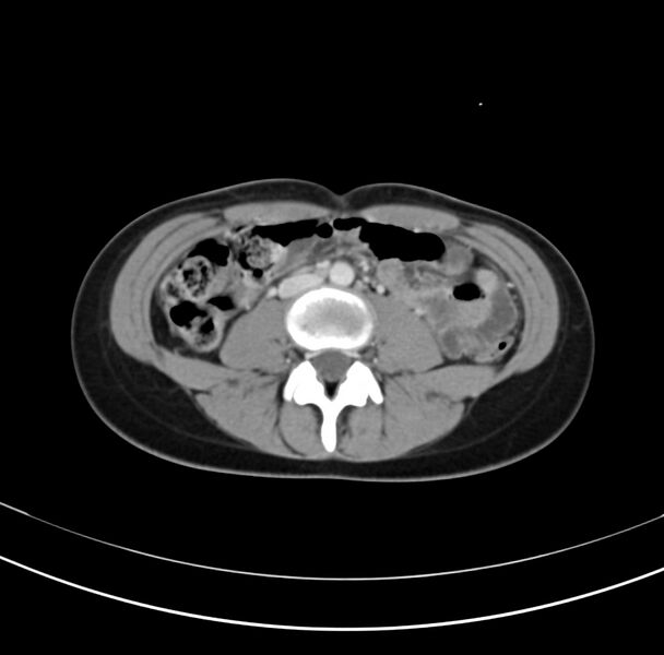 File:Appendicitis and incidental bicornuate uterus (Radiopaedia 22833-22853 B 24).jpg