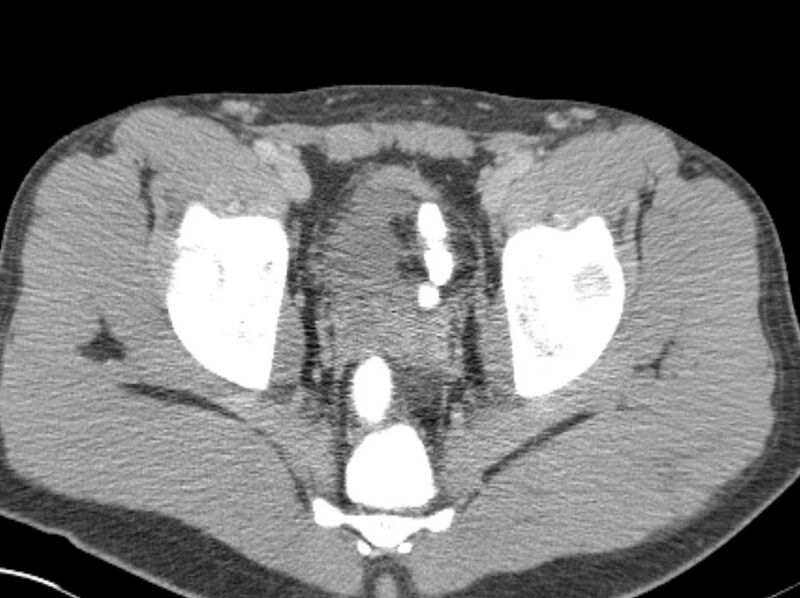 File:Appendicitis and incidental foregut duplication cyst (Radiopaedia 52962-58916 A 94).jpg