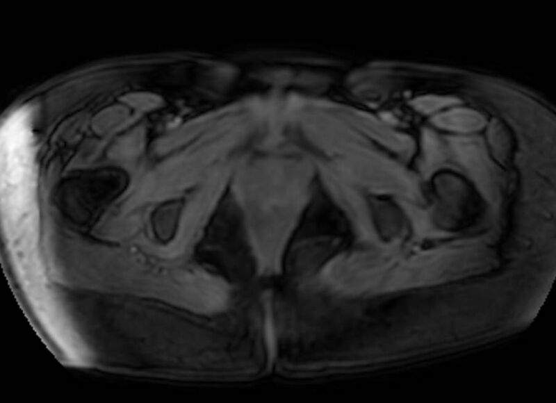 File:Appendicitis in gravida (MRI) (Radiopaedia 89433-106395 Axial DIXON 154).jpg