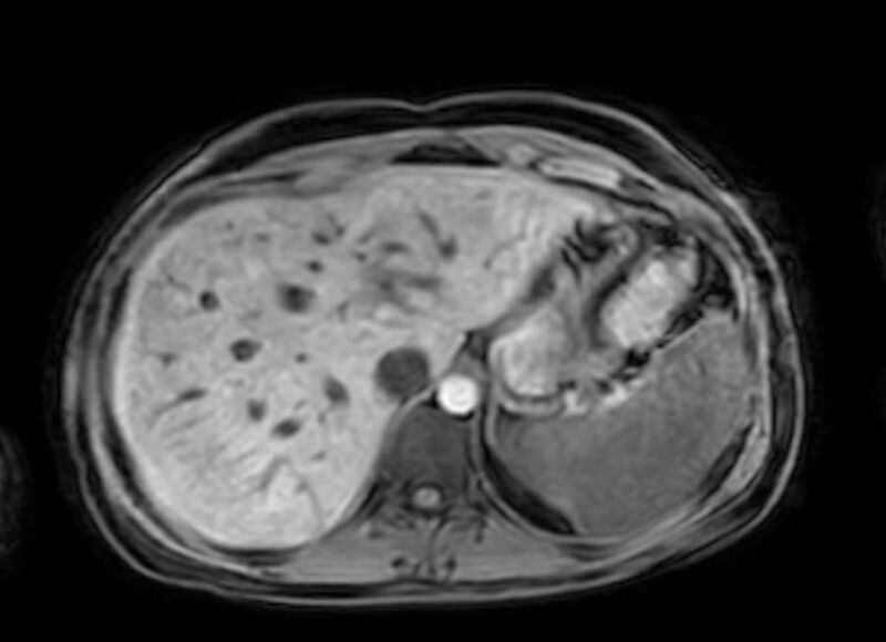 File:Appendicitis in gravida (MRI) (Radiopaedia 89433-106395 Axial DIXON 19).jpg