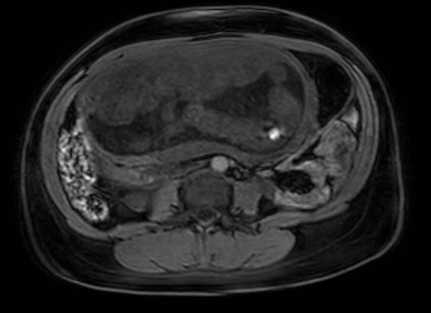 Appendicitis in gravida (MRI) (Radiopaedia 89433-106395 Axial DIXON 73).jpg