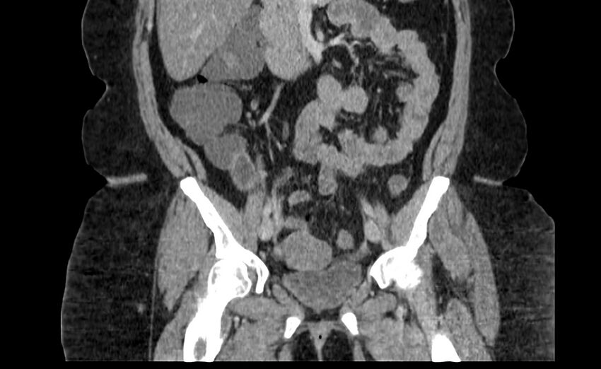Appendix mucocele (Radiopaedia 41222-44033 B 37).jpg
