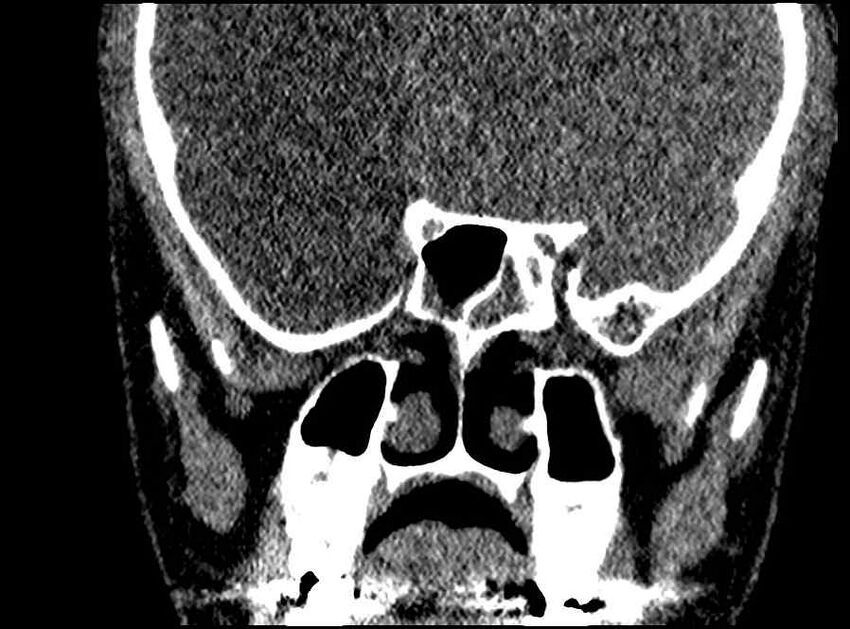 Arachnoid cyst- extremely large (Radiopaedia 68741-78450 Coronal bone window 30).jpg
