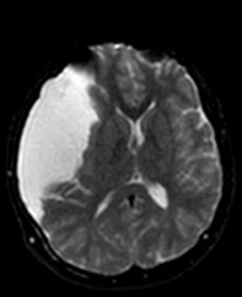 File:Arachnoid cyst- extremely large (Radiopaedia 68741-78451 Axial DWI 14).jpg