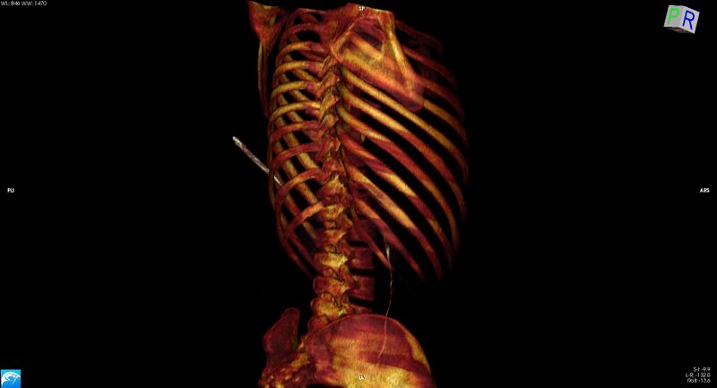 File:Arrow injury to the chest (Radiopaedia 75223-86321 3D bone 28).jpg