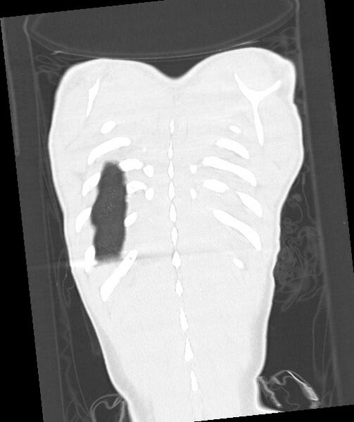 File:Arrow injury to the chest (Radiopaedia 85367-100975 Coronal lung window 116).jpg