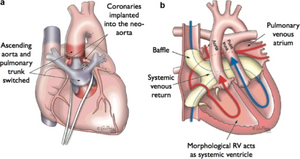 Arterial and atrial switch.png