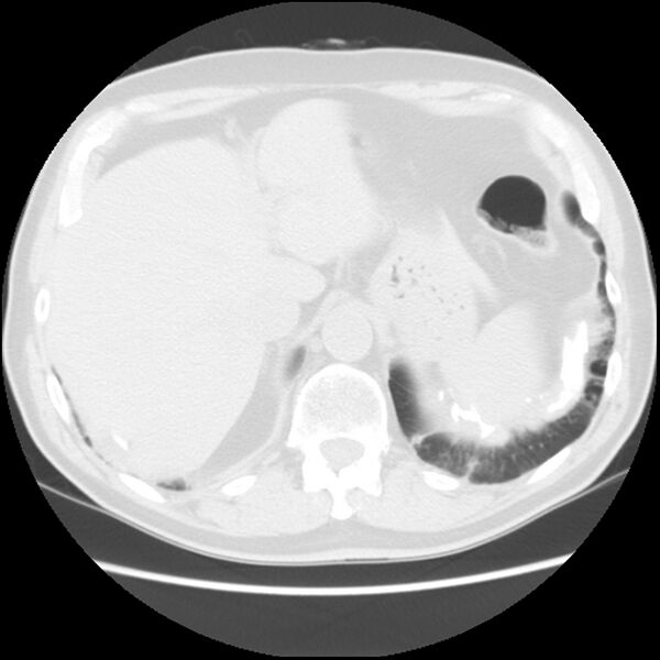 File:Asbestos-related pleural plaques (Radiopaedia 39069-41255 Axial lung window 65).jpg
