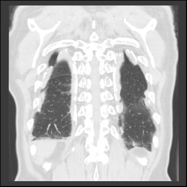File:Asbestos-related pleural plaques (Radiopaedia 39069-41255 Coronal lung window 12).jpg