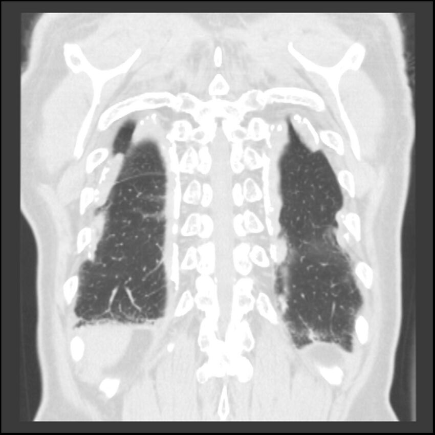 Asbestos-related pleural plaques (Radiopaedia 39069-41255 Coronal lung window 12).jpg