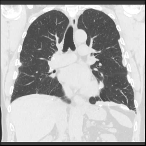File:Asbestos-related pleural plaques (Radiopaedia 39069-41255 Coronal lung window 44).jpg