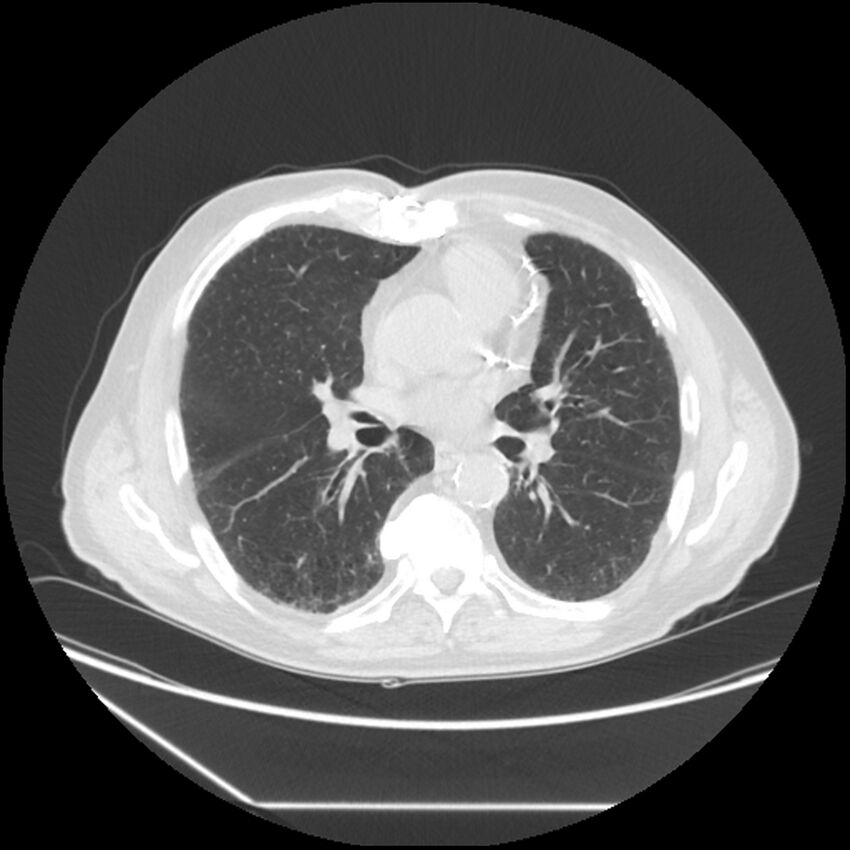 Asbestosis complicated by lung cancer (Radiopaedia 45834-50116 Axial lung window 36).jpg