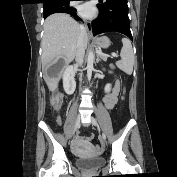 File:Ascending retrocecal appendicitis with liver abscesses (Radiopaedia 60066-67615 C 17).jpg