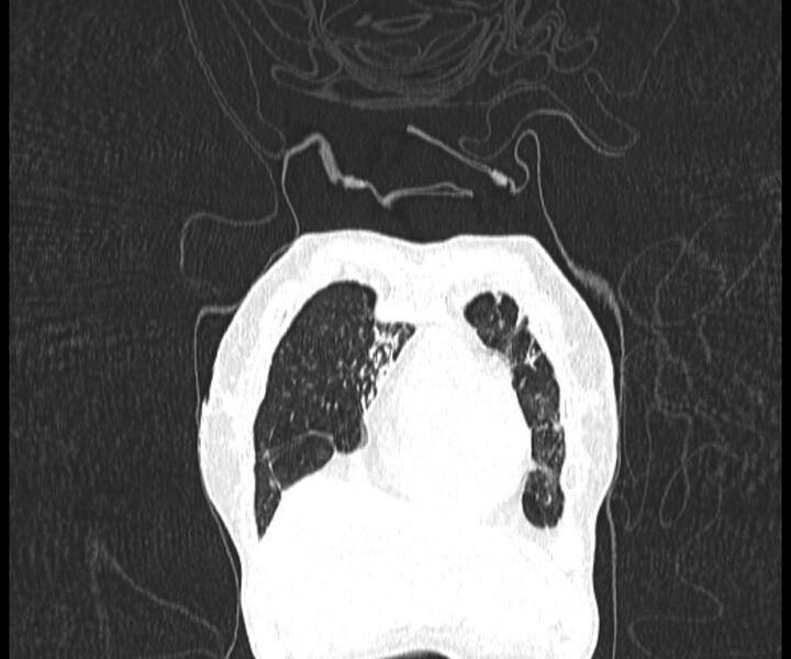 File:Aspergillomas (Radiopaedia 66779-76110 Coronal lung window 2).jpg