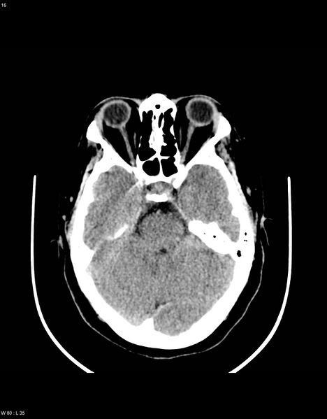 File:Astroblastoma (Radiopaedia 39792-42216 Axial non-contrast 15).jpg