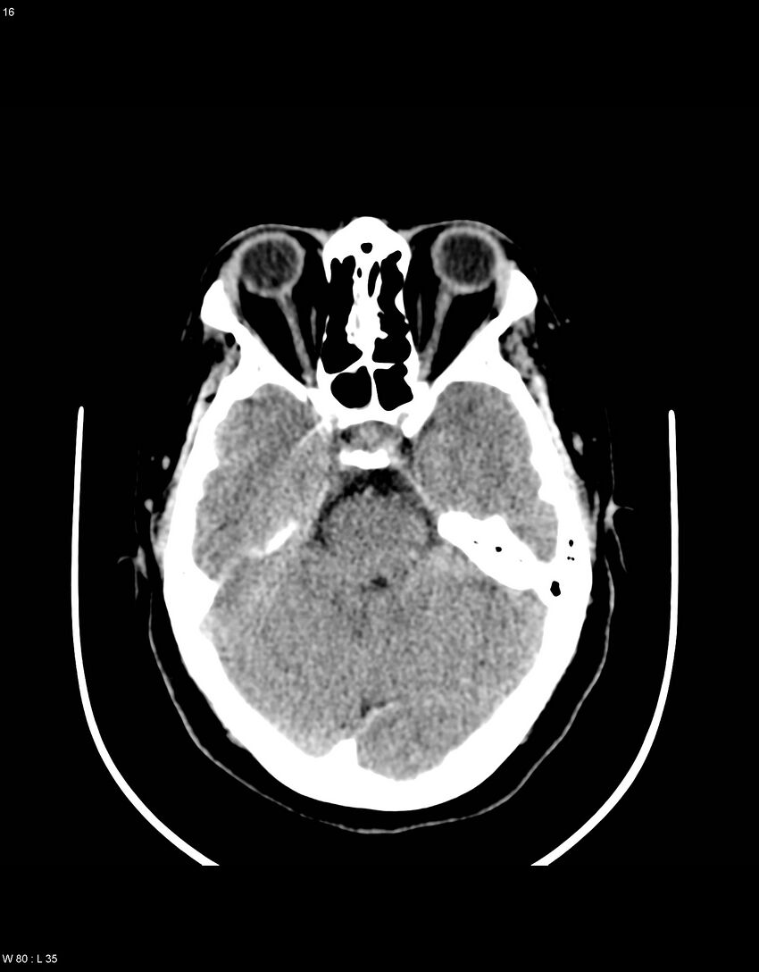 Astroblastoma (Radiopaedia 39792-42216 Axial non-contrast 15).jpg